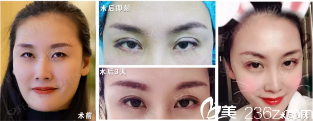 非思運營助理田欣靈埋線雙眼皮+開后眼角 非思運營助理田欣靈埋線雙眼皮+開后眼角