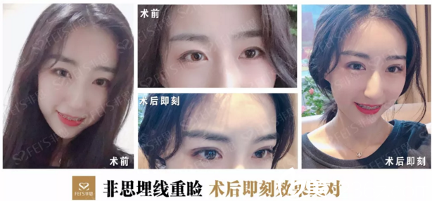 非思前臺代妍埋線雙眼皮效果 非思前臺代妍埋線雙眼皮效果