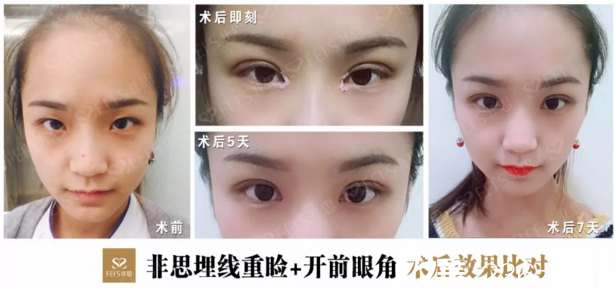 非思護(hù)士琳琳埋線雙眼皮+開內(nèi)眼角術(shù)后效果對比 非思護(hù)士琳琳埋線雙眼皮+開內(nèi)眼角術(shù)后效果對比