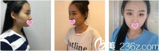 昆明吳氏嘉美卓星美容醫(yī)院張昕霞全切雙眼皮+假體隆鼻真人案例術(shù)前照 昆明吳氏嘉美卓星美容醫(yī)院張昕霞全切雙眼皮+假體隆鼻真人案例術(shù)前照