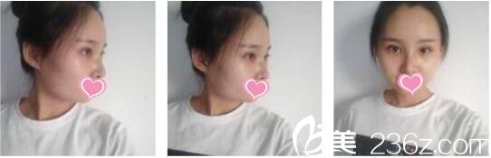 昆明吳氏嘉美卓星美容醫(yī)院張昕霞全切雙眼皮+假體隆鼻真人案例術(shù)后第七天 昆明吳氏嘉美卓星美容醫(yī)院張昕霞全切雙眼皮+假體隆鼻真人案例術(shù)后第七天