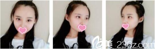 昆明吳氏嘉美卓星美容醫(yī)院張昕霞全切雙眼皮+假體隆鼻真人案例術(shù)后二十<span style= 昆明吳氏嘉美卓星美容醫(yī)院張昕霞全切雙眼皮+假體隆鼻真人案例術(shù)后二十<span style=