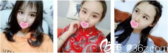 愛美的我去昆明吳氏嘉美卓星找張昕霞做了全切雙眼皮+假體隆鼻，一個(gè)月的時(shí)間就恢復(fù)的差不多了