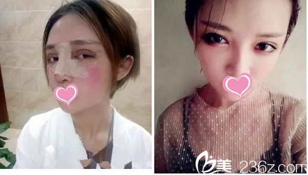 宜春韓美醫(yī)療美容醫(yī)院雙眼皮手術(shù)案例