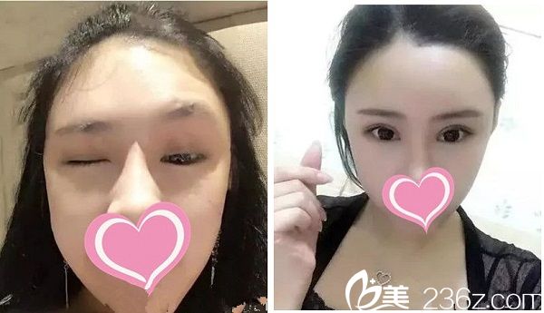 宜春華美整形醫(yī)院雙眼皮手術(shù)案例