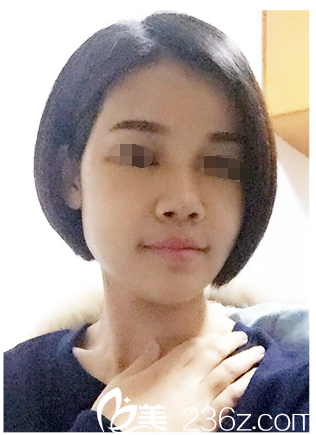 術后十天自體脂肪填充恢復中 術后十天自體脂肪填充恢復中