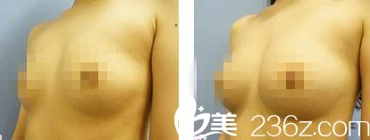 自體脂肪注入法