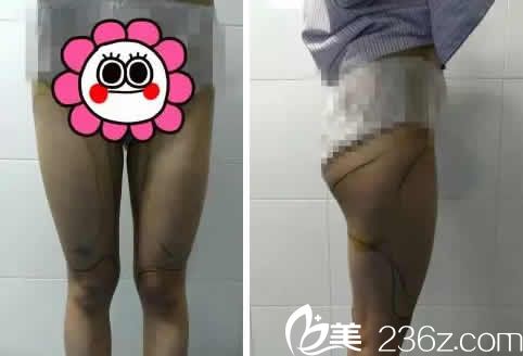 我在聊城韓美整形醫(yī)院做腿部吸脂前的照片 我在聊城韓美整形醫(yī)院做腿部吸脂前的照片