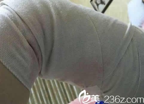 我在聊城韓美整形做水動(dòng)力腿部吸脂手術(shù)當(dāng)天照片 我在聊城韓美整形做水動(dòng)力腿部吸脂手術(shù)當(dāng)天照片