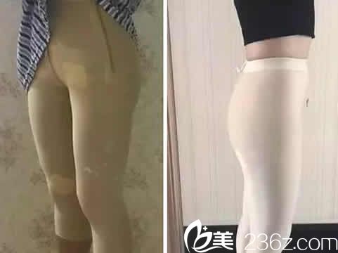 我在聊城韓美整形做無(wú)痛水動(dòng)力吸脂后第3天照片 我在聊城韓美整形做無(wú)痛水動(dòng)力吸脂后第3天照片