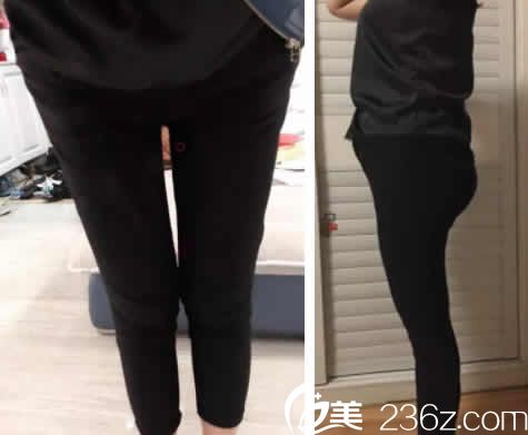 來看我在聊城韓美整形做無痛360水動力腿部吸脂7天恢復(fù)圖及真實經(jīng)歷