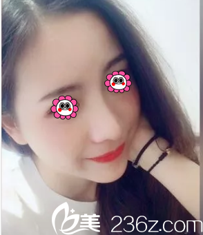 我在北京櫻桃花六萬余做這肋軟骨鼻綜合隆鼻效果來看決定沒錯