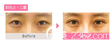 20181101_1541040566121059.png 雙眼皮2.png