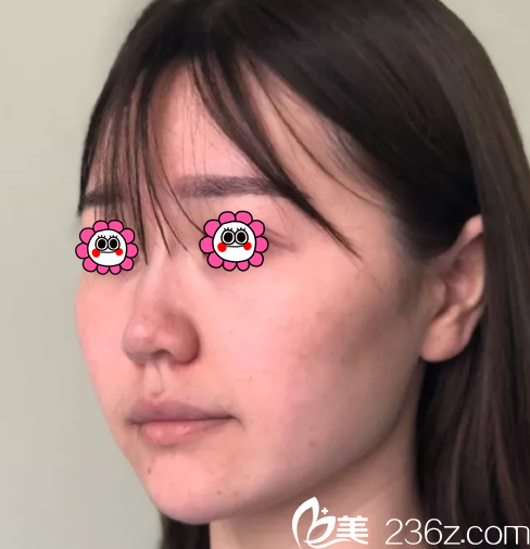 在北京櫻桃做面部埋線提升之前樣子 在北京櫻桃做面部埋線提升之前樣子