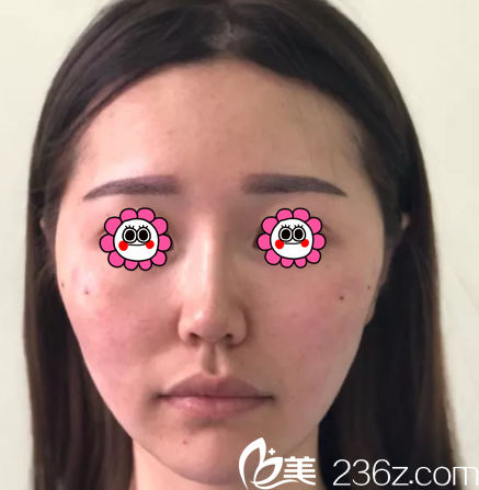 做面部埋線提升第8天 做面部埋線提升第8天