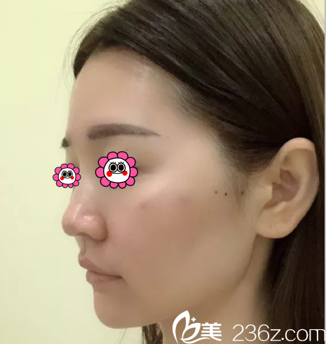 在北京櫻桃做面部埋線提升第27天 在北京櫻桃做面部埋線提升第27天