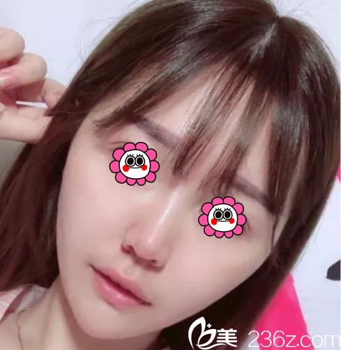 北京櫻桃面部埋線提升 北京櫻桃面部埋線提升