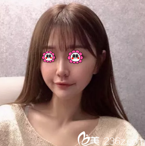 我在北京櫻桃做面部埋線提升之前是有了解價格