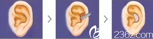 耳軟骨的去除過(guò)程