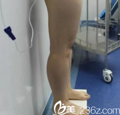 在北京櫻桃做腿部吸脂前樣子 在北京櫻桃做腿部吸脂前樣子