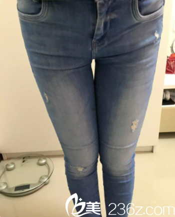 北京櫻桃腿部吸脂 北京櫻桃腿部吸脂