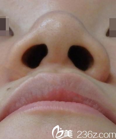 鼻翼縮小術(shù)前 鼻翼縮小術(shù)前