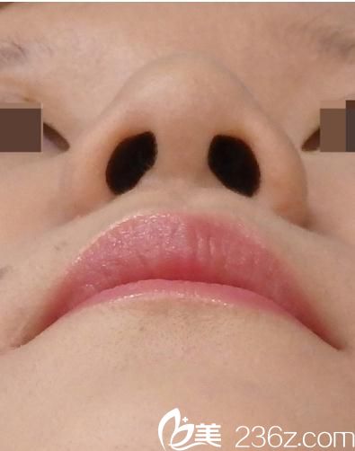 術(shù)后三個(gè)月 術(shù)后三個(gè)月