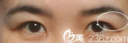 南陽維多利亞整形改善腫泡眼