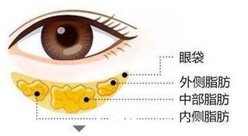 南陽維多利亞整形眼部吸脂改善腫泡眼