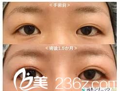 切開法雙眼皮 切開法雙眼皮