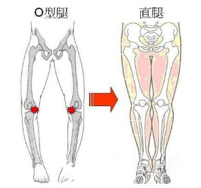 O型腿矯正