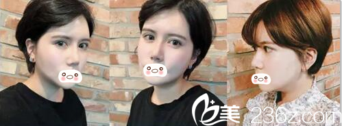 術后2周面部腫脹 術后2周面部腫脹