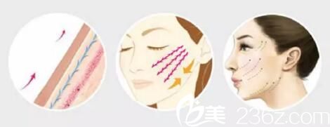 面部埋線提升示意圖