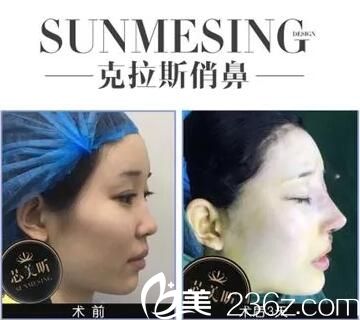 長沙芯美昕克拉斯俏鼻真人案例展示