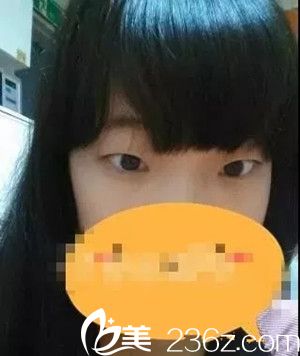 雙眼皮手術前照片 雙眼皮手術前照片