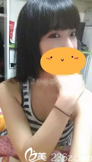 妹子在吉安天使整形醫(yī)院做雙眼皮手術(shù)后的恢復(fù)日記