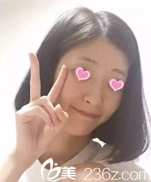 隆鼻手術(shù)前 隆鼻手術(shù)前