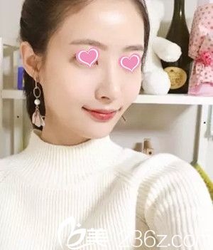 假體隆鼻后15天 假體隆鼻后15天