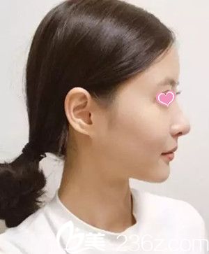 隆鼻后側(cè)面照 隆鼻后側(cè)面照