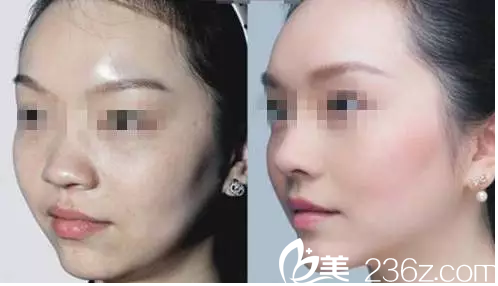 吳豫芳醫(yī)師微整形除皺案例 吳豫芳醫(yī)師微整形除皺案例