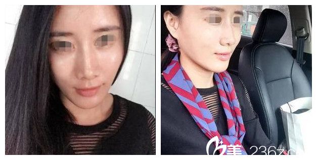 面診才知道無錫麗都是原來的，來看我找陳光平院長做的自體脂肪面部填充術(shù)后多圖分享