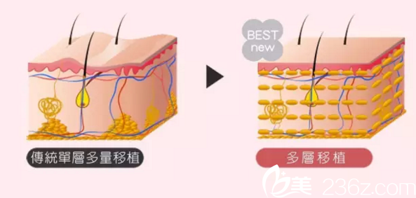 納米自體脂肪填充的優(yōu)勢