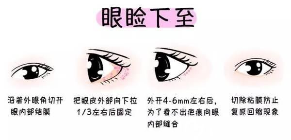 眼瞼下至的手術(shù)方法