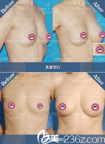 北京聯(lián)合麗格楊大平隆胸案例