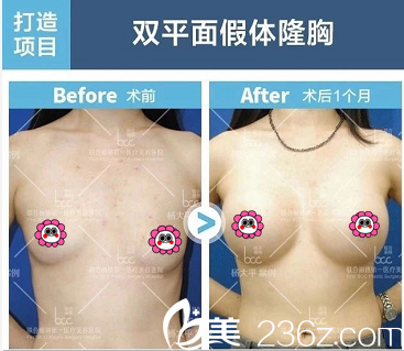 北京聯(lián)合麗格楊大平雙平面假體隆胸案例