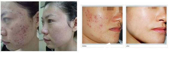 紅藍(lán)光祛痘前后對(duì)比案例
