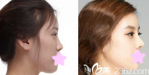 聊城韓美整形鼻綜合隆鼻效果圖