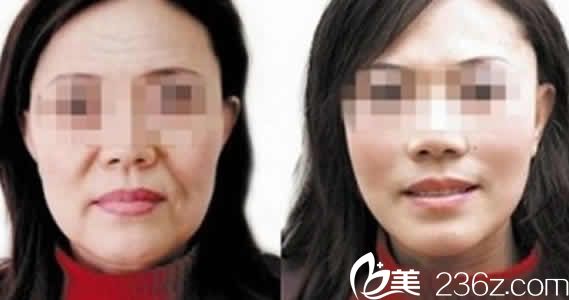 聊城韓美整形面部注射除皺效果圖