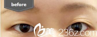 埋線法雙眼皮 前