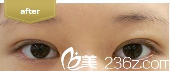 埋線法雙眼皮  